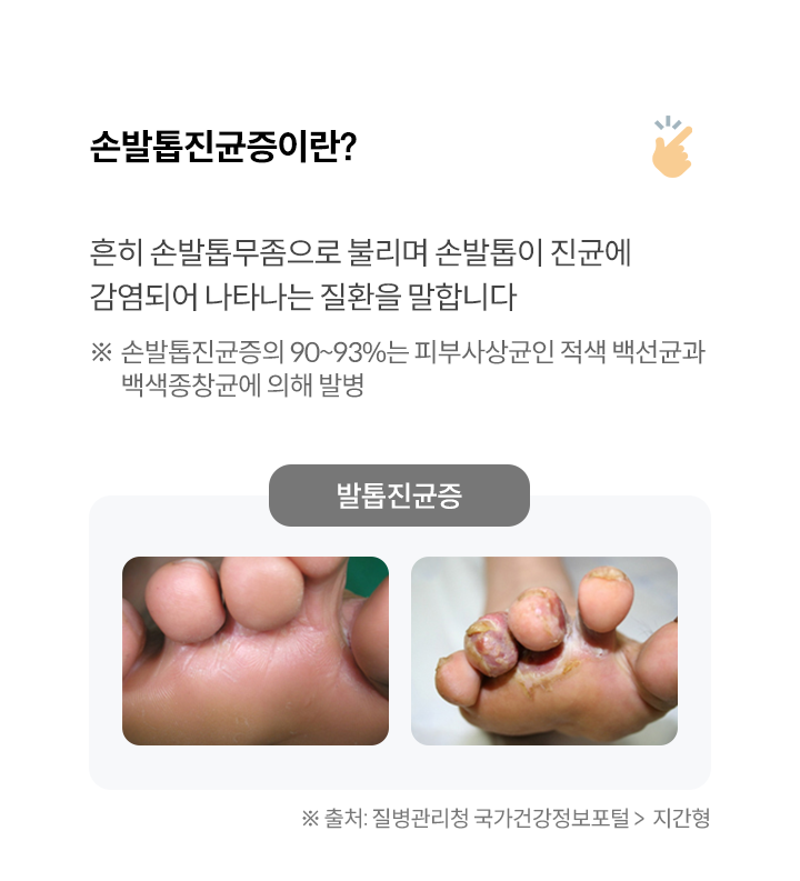 손발톱진균증이란?