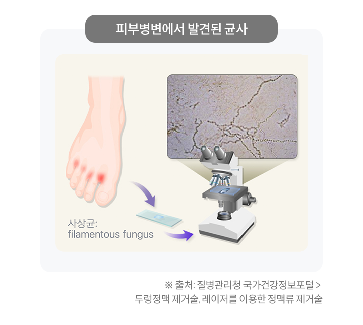 피부병변에서 발견된 균사 - 사상균(filamentous fungus)