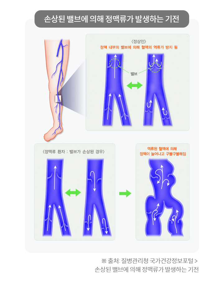 손상된 밸브에 의해 정맥류가 발생하는 기전