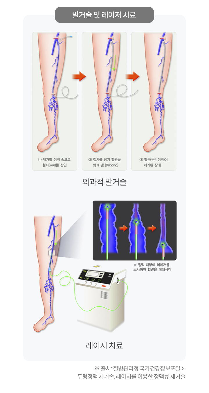 발거술 및 레이저 치료