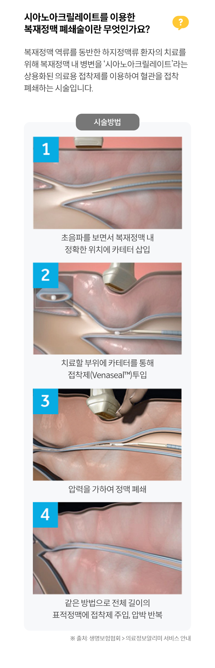 시아노아크릴레이트를 이용한 
                복재정맥 폐쇄술이란 무엇인가요?